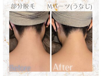 ベルココレ(Bellecocole)/部分脱毛1回(うなじ)