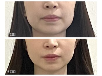 タイナ 岡山(taina)/小顔矯正