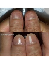 ティアラネイル 宇都宮/深爪矯正