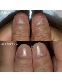 ティアラネイル 宇都宮/深爪矯正