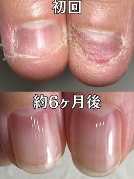イズム(Izm)の写真/《お悩み爪特化》深爪・丸爪に本気で向き合う美爪育成サロン！