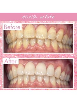 エクシアホワイトニング 四日市店/ホワイトニングビフォーアフター