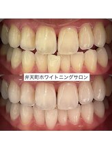 弁天町駅前整体院/セルフホワイトニング効果