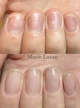 マリーロール 梅田店(Marie Laure)/自爪育成/深爪矯正/ネイルケア