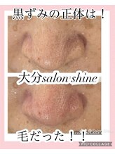 サロンシャイン(Salon Shine)/60代女性毛穴エクストラクション