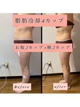 ティアメディカル(Tia Medical)/【脂肪冷却お腹+腰4カップ】