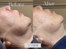 アイシス(AIsis)/【首のシワ】LDMハイプレミアム