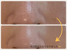 グランボヌール(grand bonheur)/【小鼻の毛穴が気になる方必見】