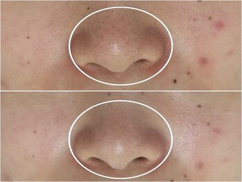 アンリミット 原宿竹下通り店(Une limit)/【毛穴の黒ずみ悩む方に】