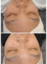 ココ(COCO)/プラズマでシミケアし放題！