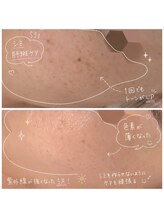 リンダ(Rinda)/シミ|色素ケア◇クリスティーナ