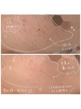 リンダ(Rinda)/シミ|色素ケア◇クリスティーナ