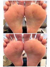 ヒールネイル(heal nail)/フット角質ケア