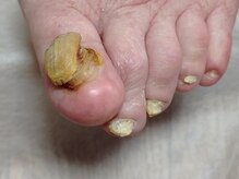 001 新横浜/分厚い変形爪も一回でキレイ