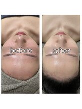 エフトゥクロリ(F to COLORIS)/プラズマシャワー × 美容液導入