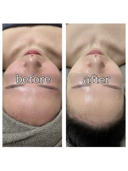 エフトゥクロリ(F to COLORIS)/プラズマシャワー × 美容液導入