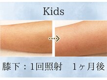 リベル(rebelle)/すね毛脱毛（膝下）