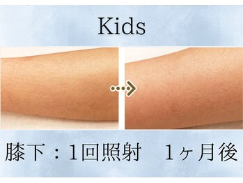 リベル(rebelle)/すね毛脱毛（膝下）