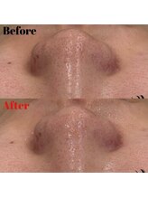 ビーブルーセブン(B.BLUE7)/【最新毛穴洗浄★症例写真】