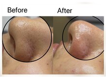 リル(Rire)/毛穴エクストラクション/上尾