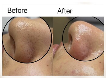 リル(Rire)/毛穴エクストラクション/上尾