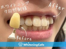 ホワイトニングカフェ 姫路駅前店(WhiteningCafe)/ホワイトニング7回照射