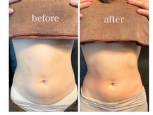 アファン 鶴見店(Afun)/ぽっこりお腹BeforeAfter