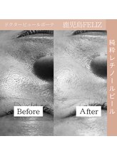 フェリス(FELIZ)/純粋レチノール（レベル1）×1回