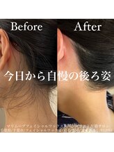 エリス(ELISSE)/うなじ脱毛