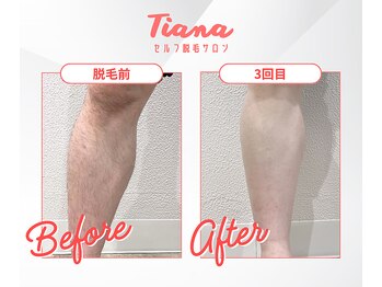 ティアナ(Tiana)/足脱毛 Before&After