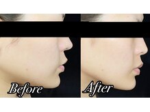 アッヴェリーレ(A'bbellire)の雰囲気(フェイスライン爆誕♪)