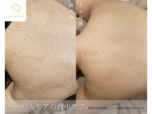ハーブピーリングで気になる背中をケア。