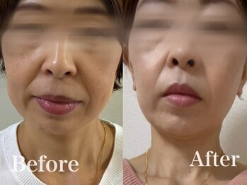 いやしの家さくら/レモンボトルビフォーアフター