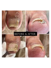 まき爪晴れる/どんな足爪トラブルにも対応