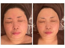 ドクター ヴィーナス/グランスキンハーブ　1回