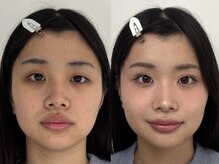 ベル(belle)/Before After