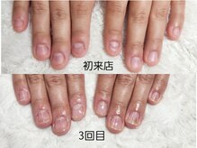 グラシナ なんば店/深爪/自爪育成/フィルイン