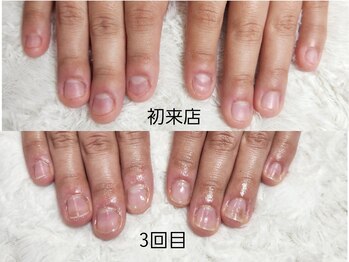 グラシナ なんば店/深爪/自爪育成/フィルイン