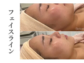 エトレ(etre)/小顔/フェイシャル/毛穴/肌荒れ