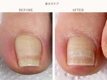 ディグニティ(Dignity)/巻き爪改善ケア