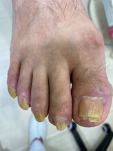 フットメンテ 巻き爪矯正センター 南浦和/肥厚爪料金　