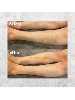 ディライト 名古屋駅店(Delight)/最新の脱毛器です