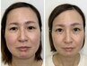 徹底小顔コース◆エラ・頬骨・むくみを一気に解消！劇的スッキリ小顔へ◎