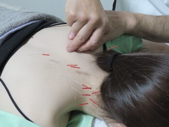 ヤマザキ治療院/首肩コリへの鍼灸