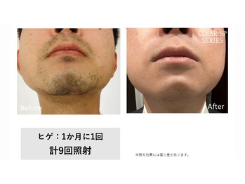 サロン ルアナ(salon luana)/ヒゲ脱毛　before→after