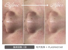 ミセル(MISEL2nd)/黒ずみ毛穴/角栓除去★毛穴洗浄