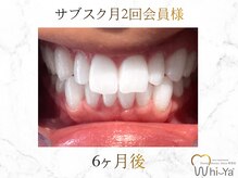 ホワイヤ セルフホワイトニング DBS神楽坂(Whi-Ya)/☆サブスク会員様☆納得の白さ☆