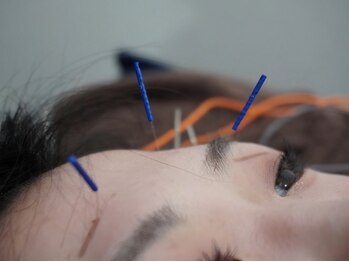 リベルタ鍼灸整骨院 なんば店(Liberta鍼灸整骨院)/美容鍼/食いしばり・眼精疲労に!