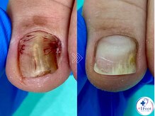 プラスワンフット 本厚木(+1 Foot)/変形・肥厚した爪を正常な爪へ
