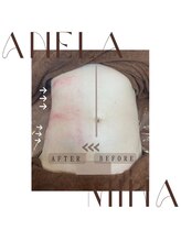 アーネラミーナ(Anela mina)/施術例